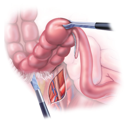 Qu'est ce que la chirurgie du colon et du rectum?