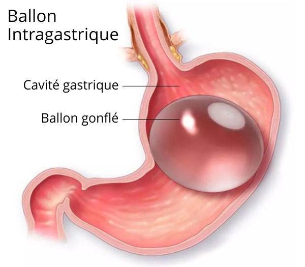 Obésité: tout savoir sur la pose d'un ballon intra gastrique: où trouver à Marseille?