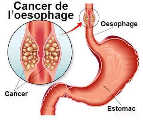 Cancer de l’œsophage : quelles sont les techniques opératoires? Est-ce une intervention lourde?