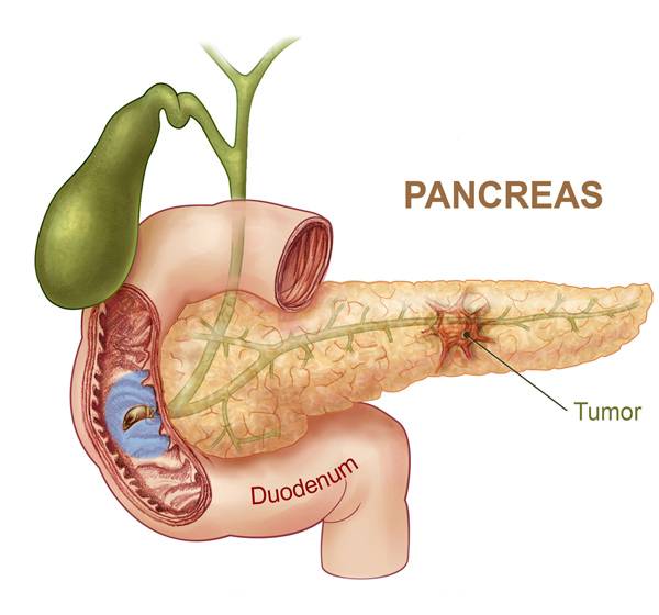 cancer du pancréas