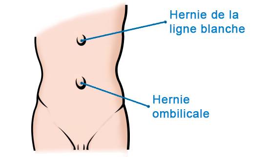 hernie ombilicale
