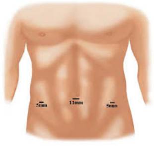 Que peut-on faire et ne pas faire après une opération de hernie inguinale ? (Efforts, port de charges lourdes, activité physique)