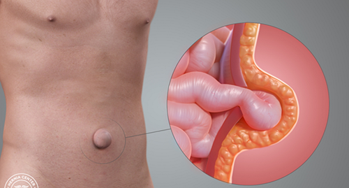 La chirurgie herniaire en ambulatoire